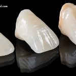 کامپوزیت ونیر دندان امریکایی