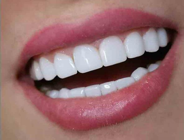 بازار فروش مواد کامپوزیت دندان ایرانی